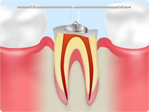 隣接する歯にフック状の器具を装着し、埋まっている部分をゆっくりと引き出します。