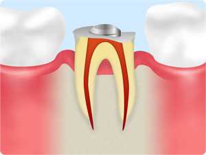 歯ぐきに埋まっていた歯の健康な部分が露出されました。