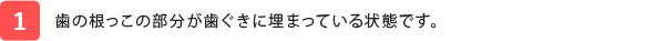 歯の根っこの部分が歯ぐきに埋まっている状態です。