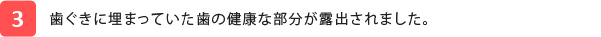 歯ぐきに埋まっていた歯の健康な部分が露出されました。