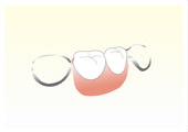 入れ歯・義歯の種類