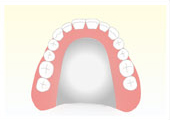 入れ歯・義歯の種類 金属で出来た入れ歯　自費治療