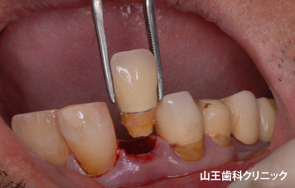 歯 を 残す 歯医者
